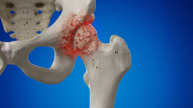 arthrose.jpg arthrose.jpg